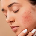 Acne.jpg